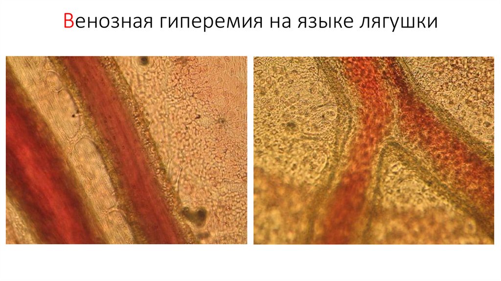 Венозная гиперемия на языке лягушки