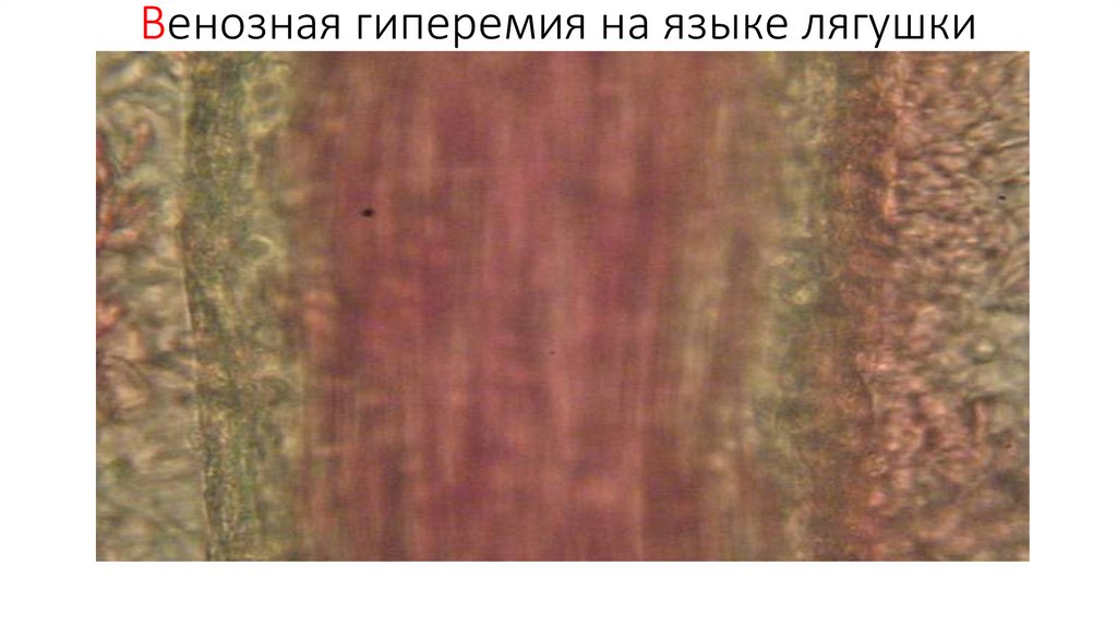 Венозная гиперемия на языке лягушки