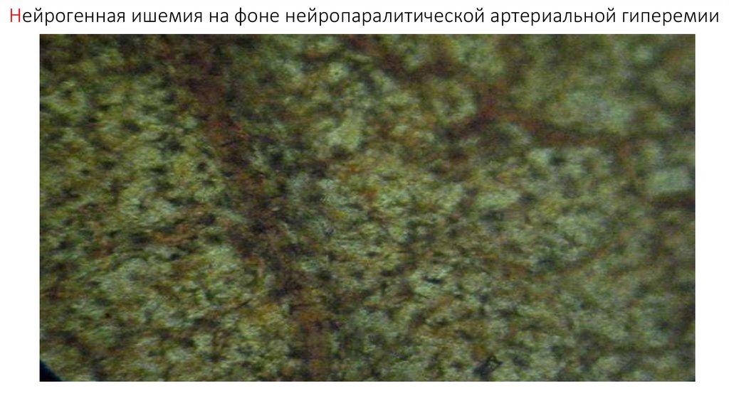 Нейрогенная ишемия на фоне нейропаралитической артериальной гиперемии