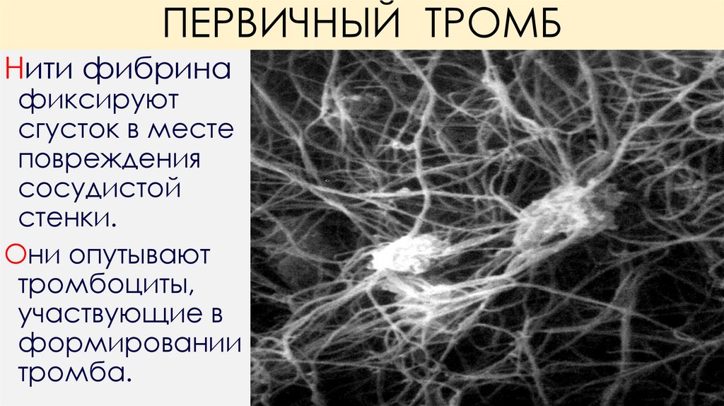 ПЕРВИЧНЫЙ ТРОМБ