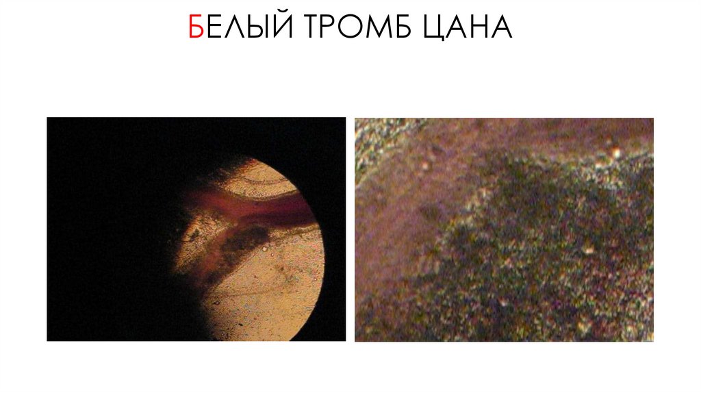 БЕЛЫЙ ТРОМБ ЦАНА