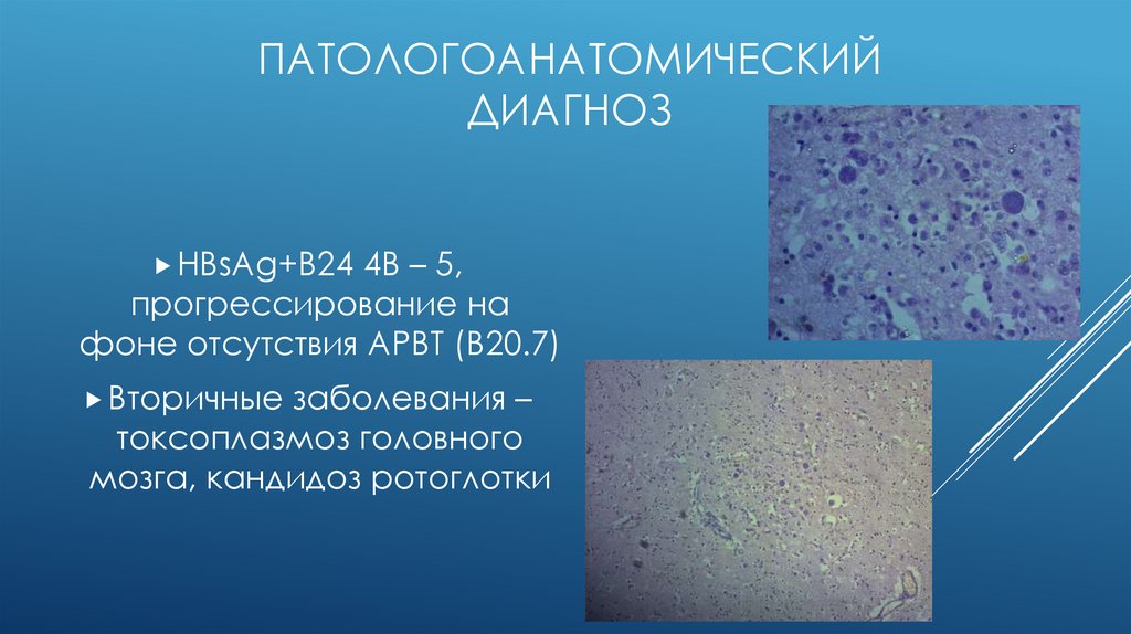 Патологоанатомический диагноз