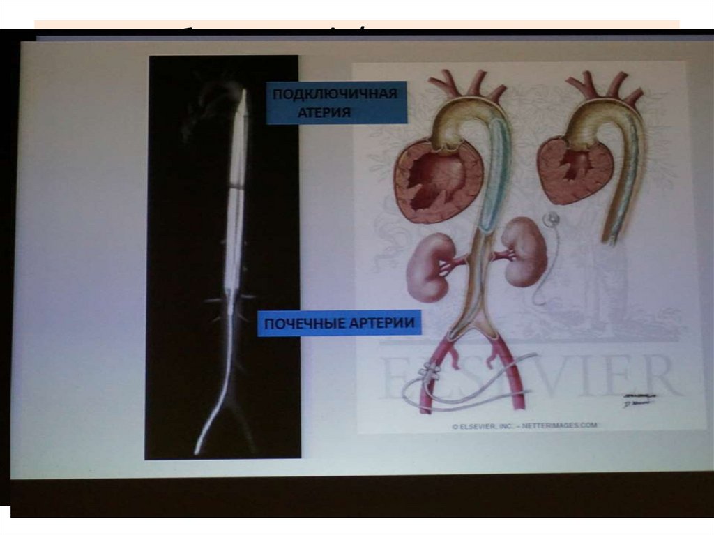 Ингибиторы IIb/IIIa рецепторов тромбоцитов