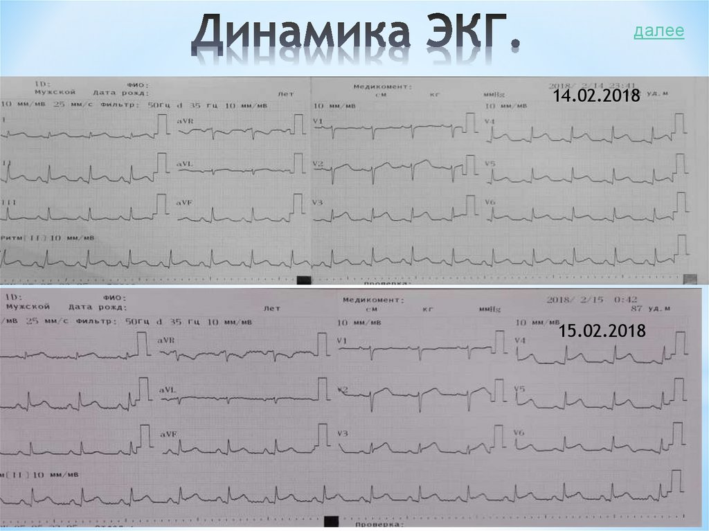 Динамика ЭКГ.