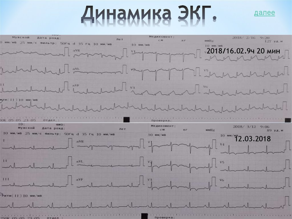 Динамика ЭКГ.