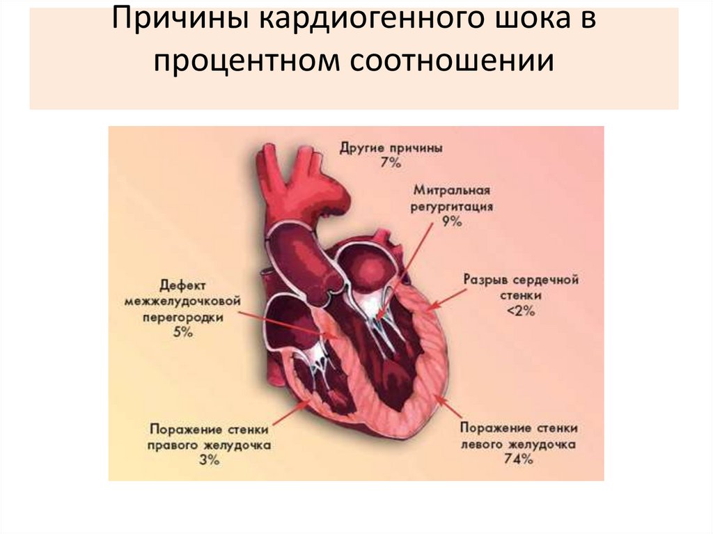Причины кардиогенного шока в процентном соотношении