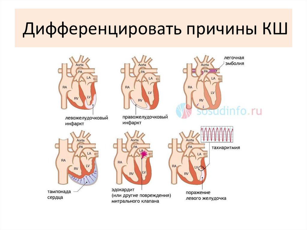 Дифференцировать причины КШ