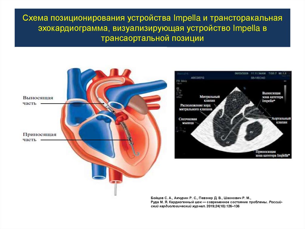 Схема позиционирования устройства Impella и трансторакальная эхокардиограмма, визуализирующая устройство Impella в