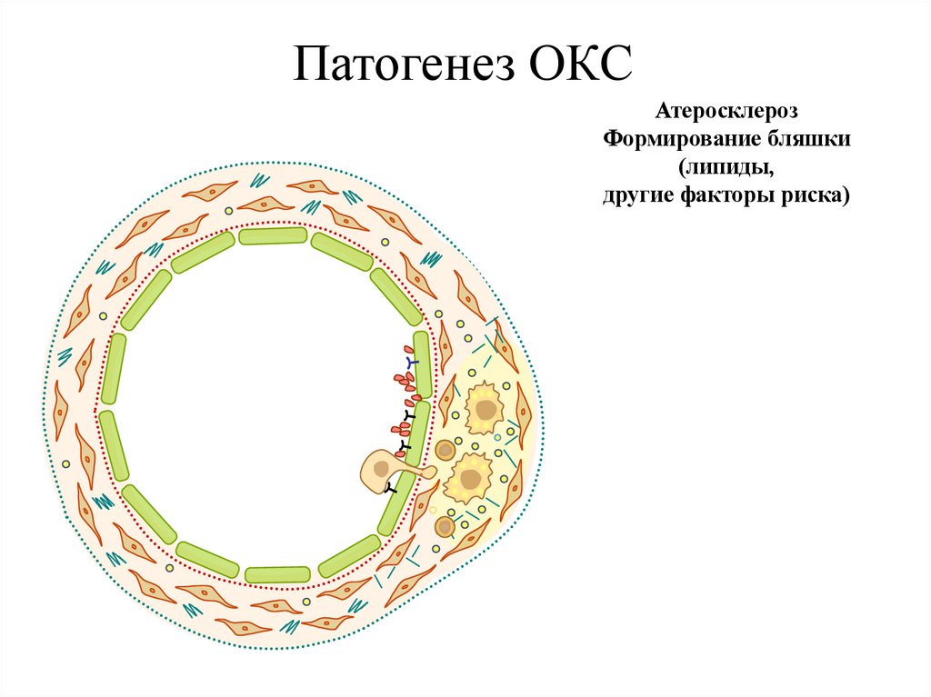 Патогенез ОКС