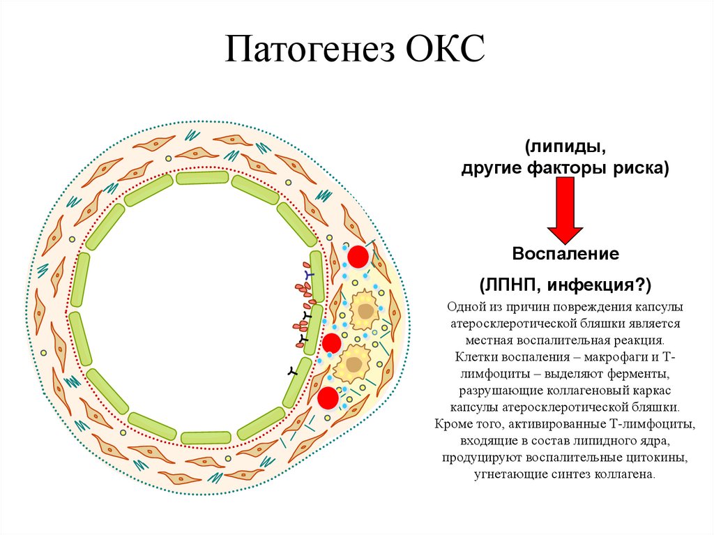 Патогенез ОКС