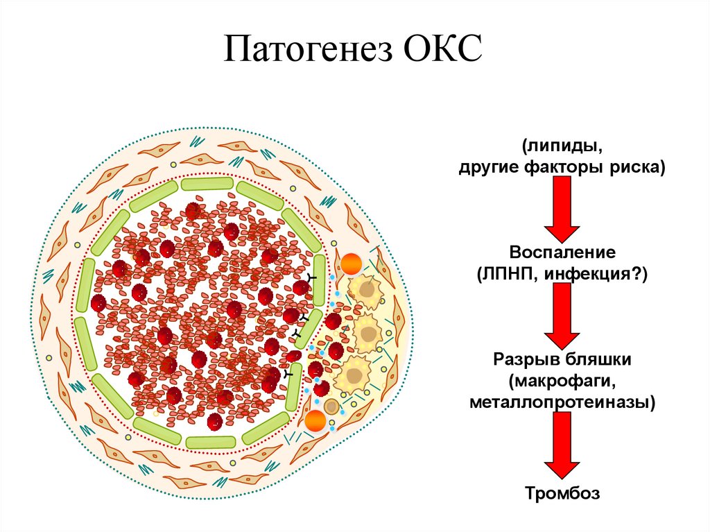 Патогенез ОКС