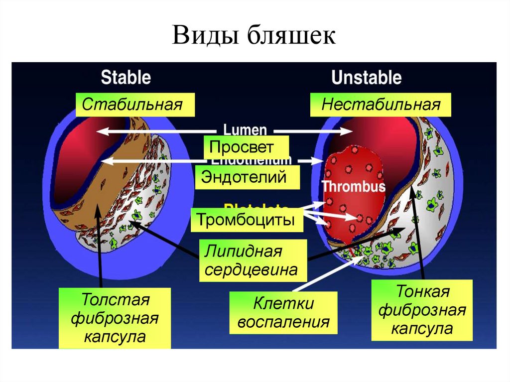 Виды бляшек
