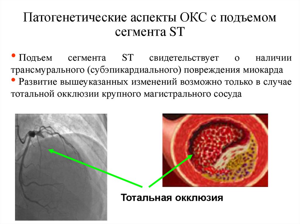 Патогенетические аспекты ОКС с подъемом сегмента ST