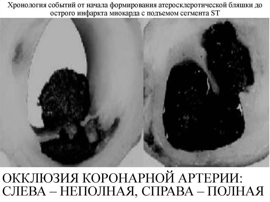 Окклюзия коронарной артерии: слева – неполная, справа – полная