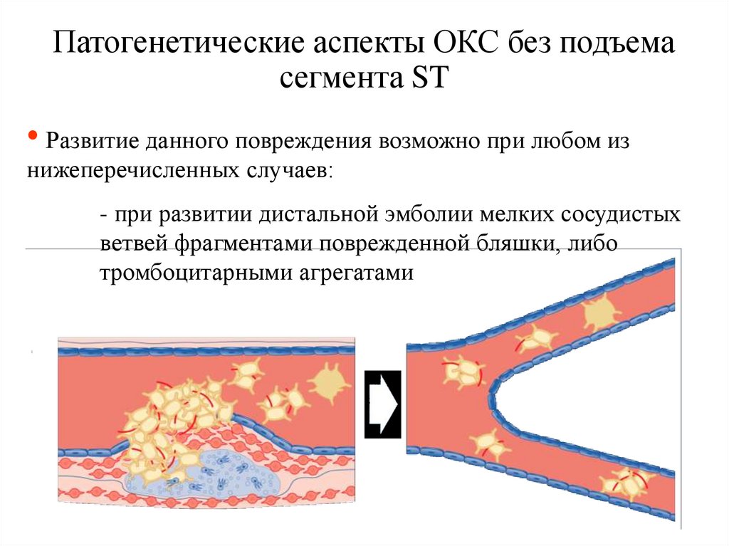 Патогенетические аспекты ОКС без подъема сегмента ST