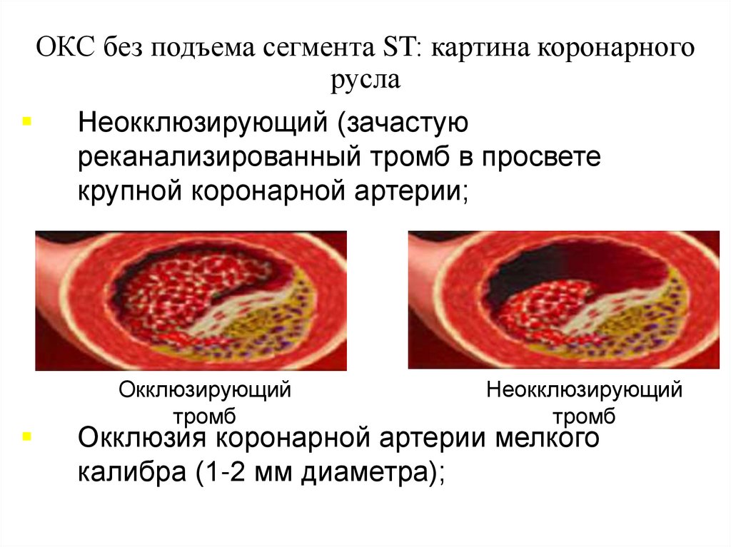 ОКС без подъема сегмента ST: картина коронарного русла