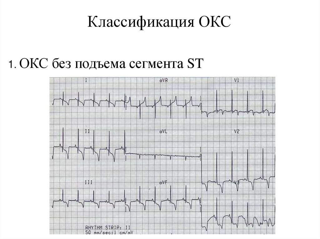 Классификация ОКС
