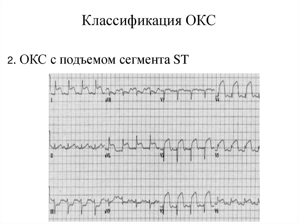 Классификация ОКС
