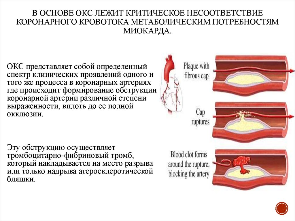 В основе ОКС лежит критическое несоответствие коронарного кровотока метаболическим потребностям миокарда.