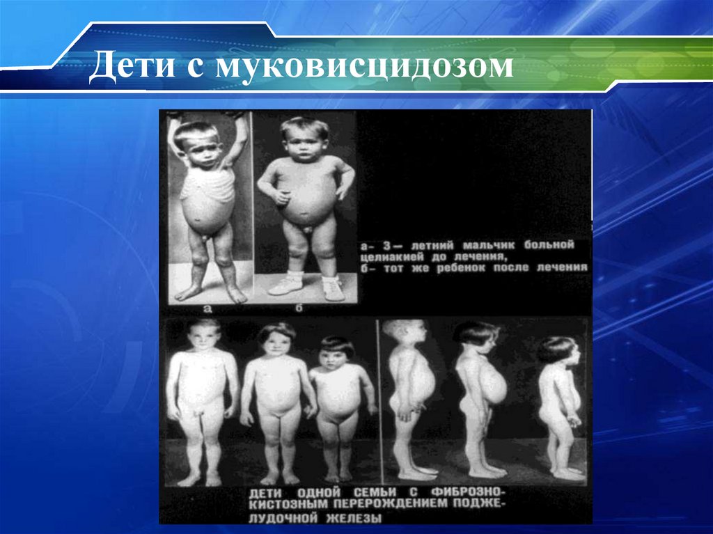 Дети с муковисцидозом