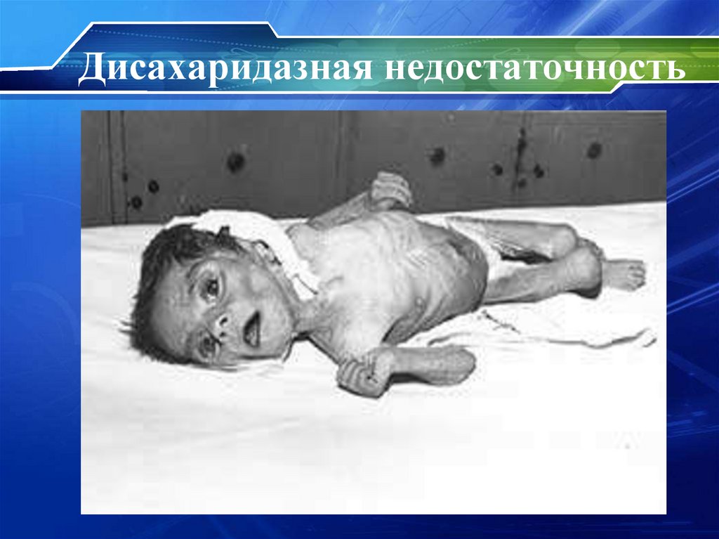 Дисахаридазная недостаточность