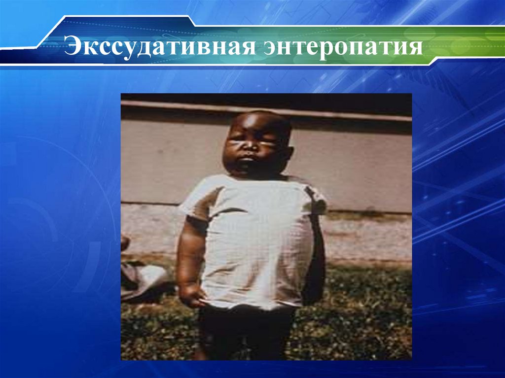 Экссудативная энтеропатия