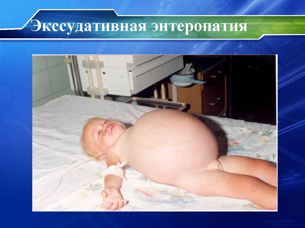 Экссудативная энтеропатия