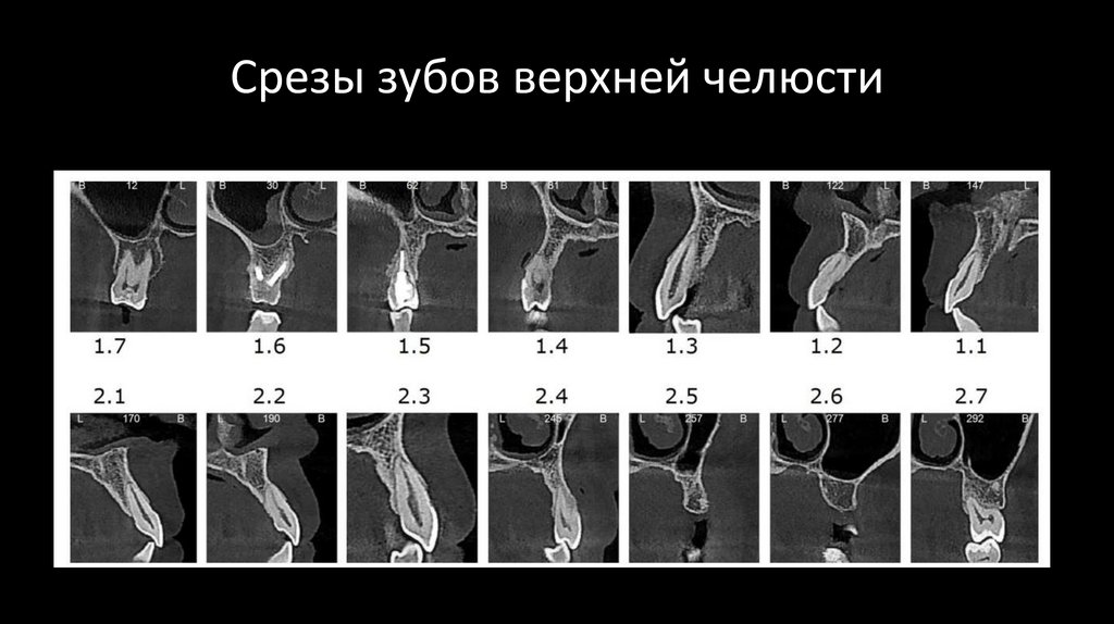 Срезы зубов верхней челюсти