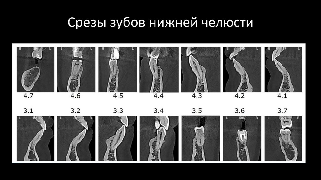 Срезы зубов нижней челюсти