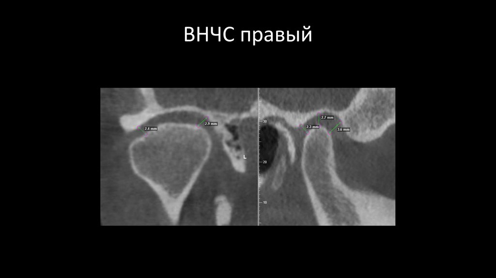 ВНЧС правый