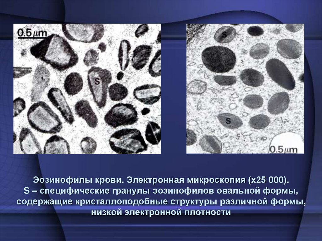Эозинофилы крови. Электронная микроскопия (х25 000). S – специфические гранулы эозинофилов овальной формы, содержащие