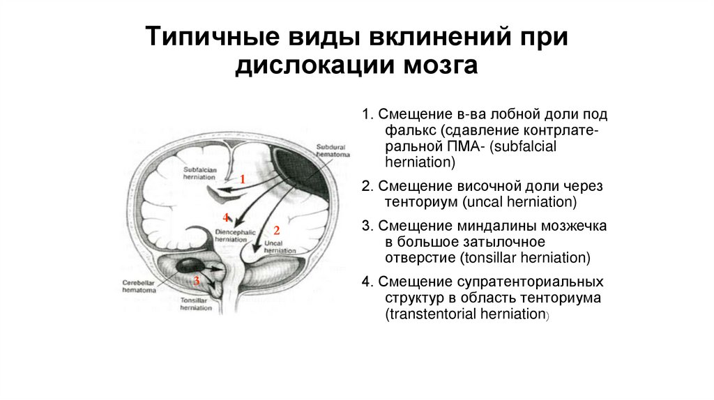 Типичные виды вклинений при дислокации мозга
