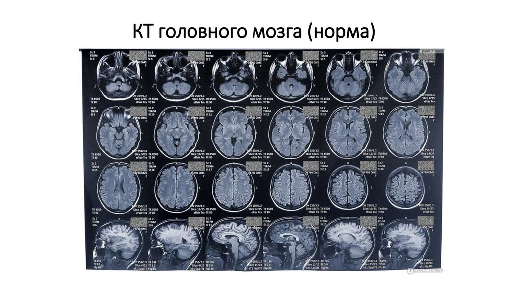 КТ головного мозга (норма)