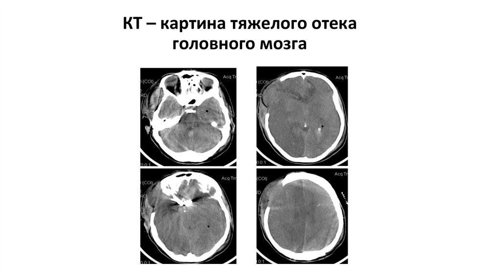 КТ – картина тяжелого отека головного мозга