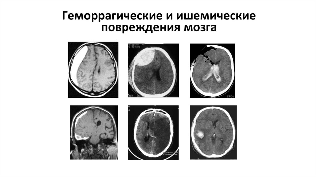 Геморрагические и ишемические повреждения мозга