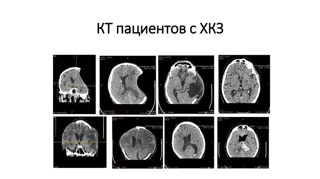 КТ пациентов с ХКЗ