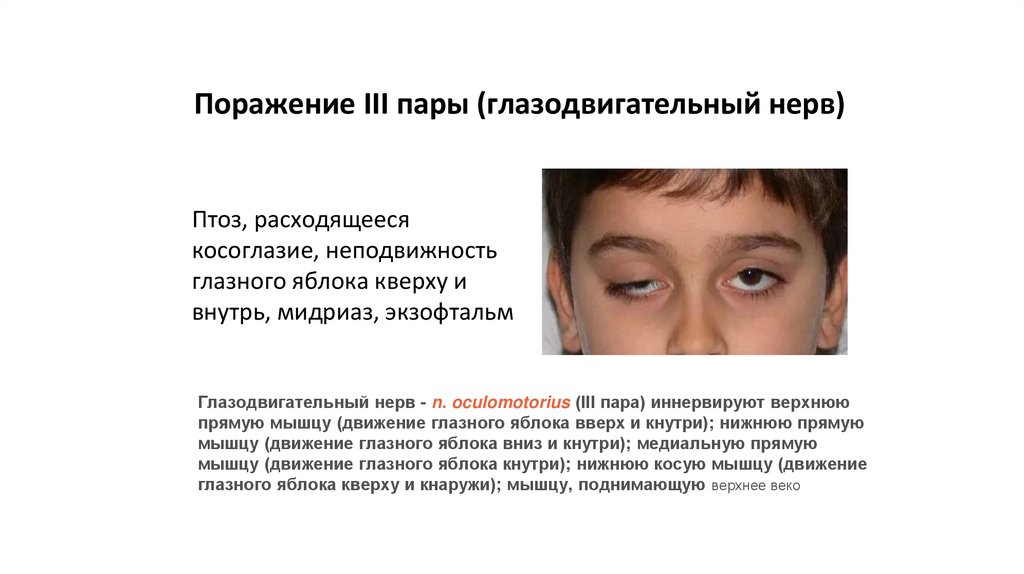 Поражение III пары (глазодвигательный нерв)