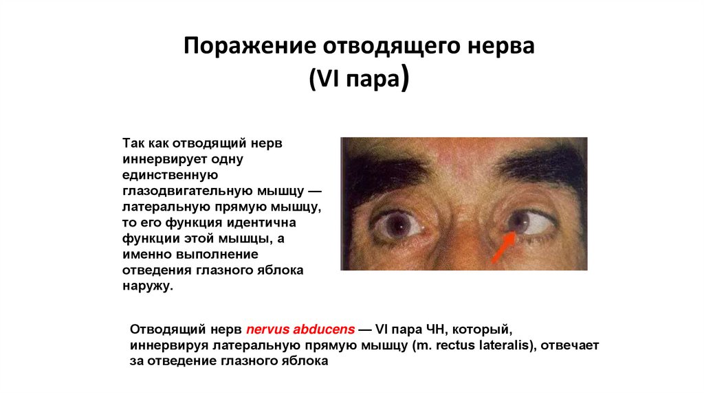 Поражение отводящего нерва (VI пара)