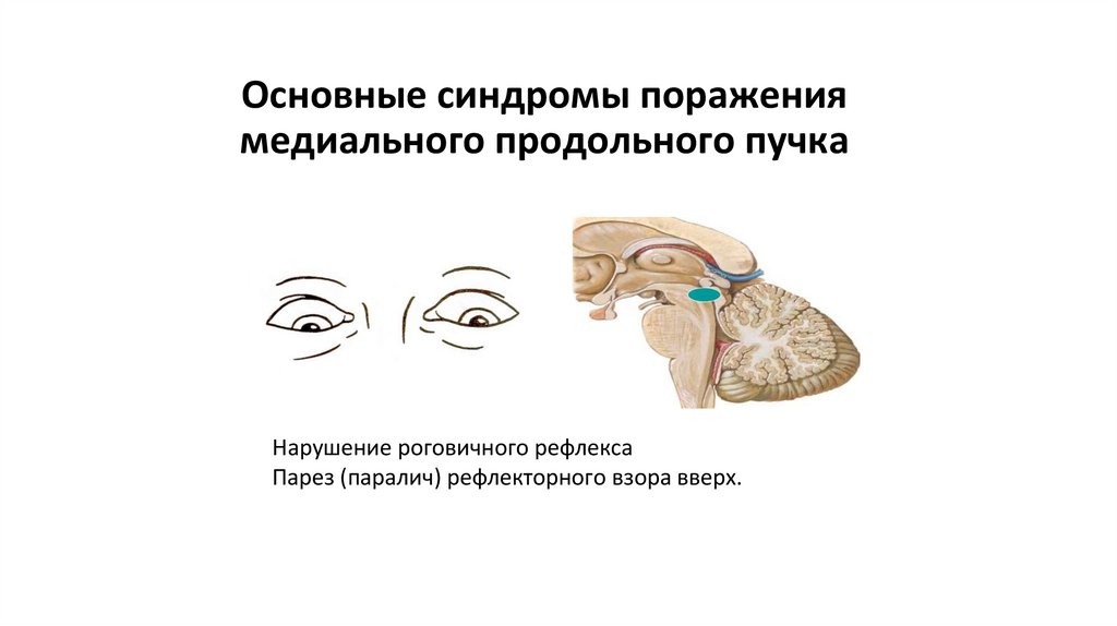 Основные синдромы поражения медиального продольного пучка