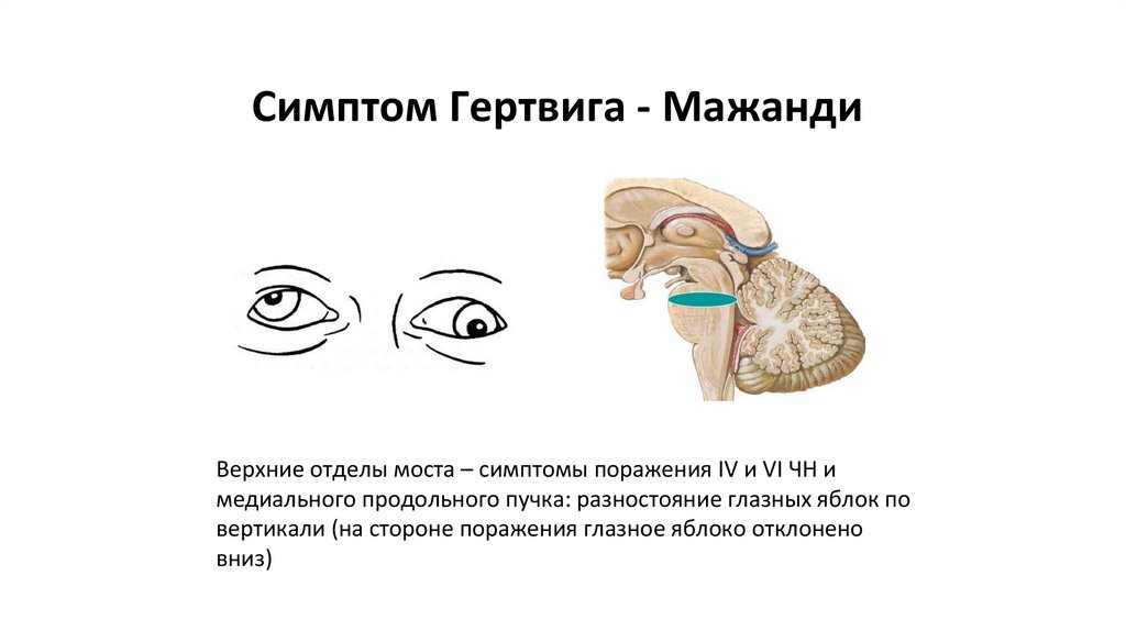 Симптом Гертвига - Мажанди