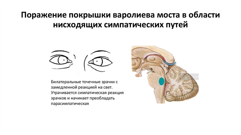 Поражение покрышки варолиева моста в области нисходящих симпатических путей