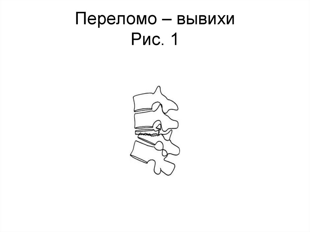 Переломо – вывихи Рис. 1