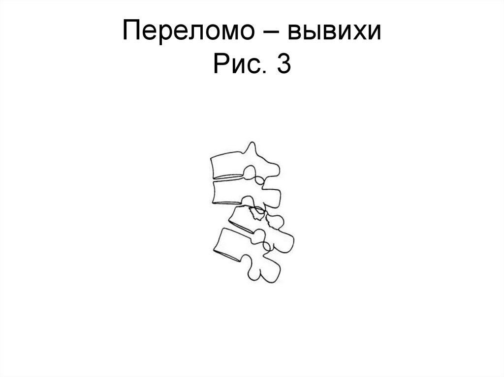 Переломо – вывихи Рис. 3