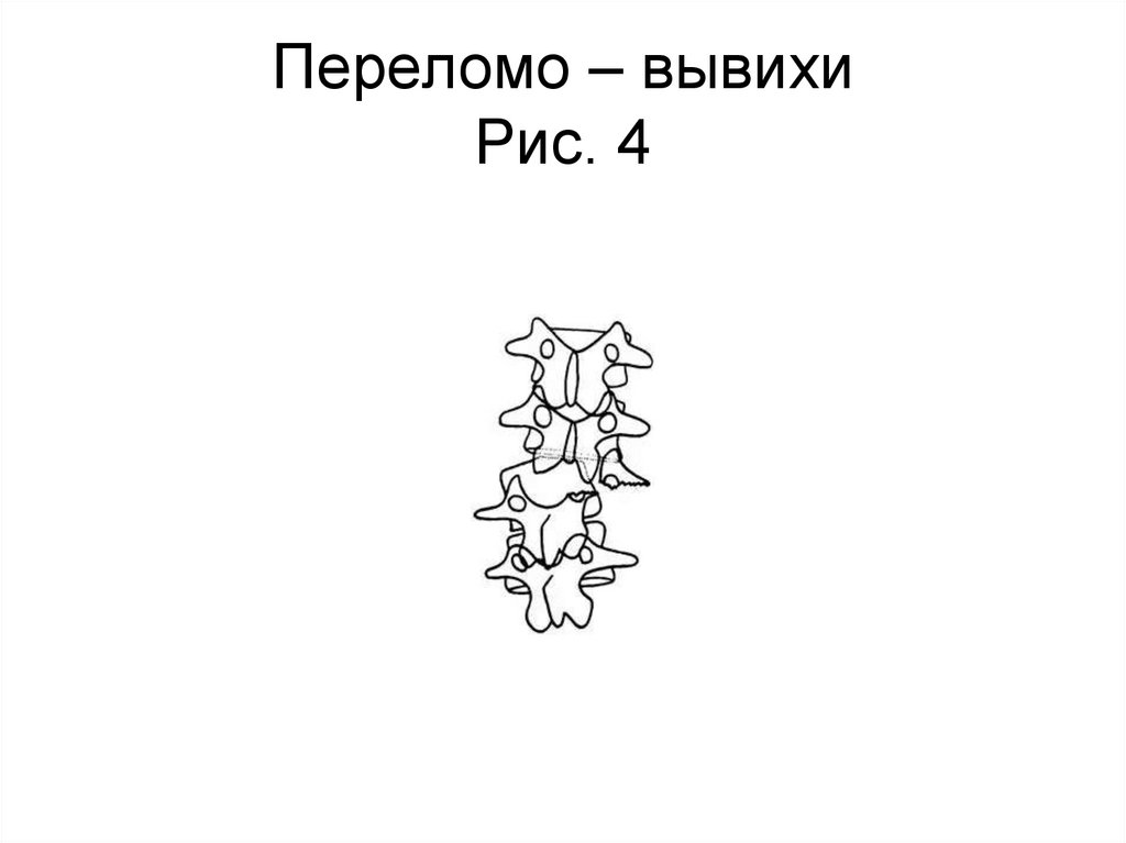 Переломо – вывихи Рис. 4