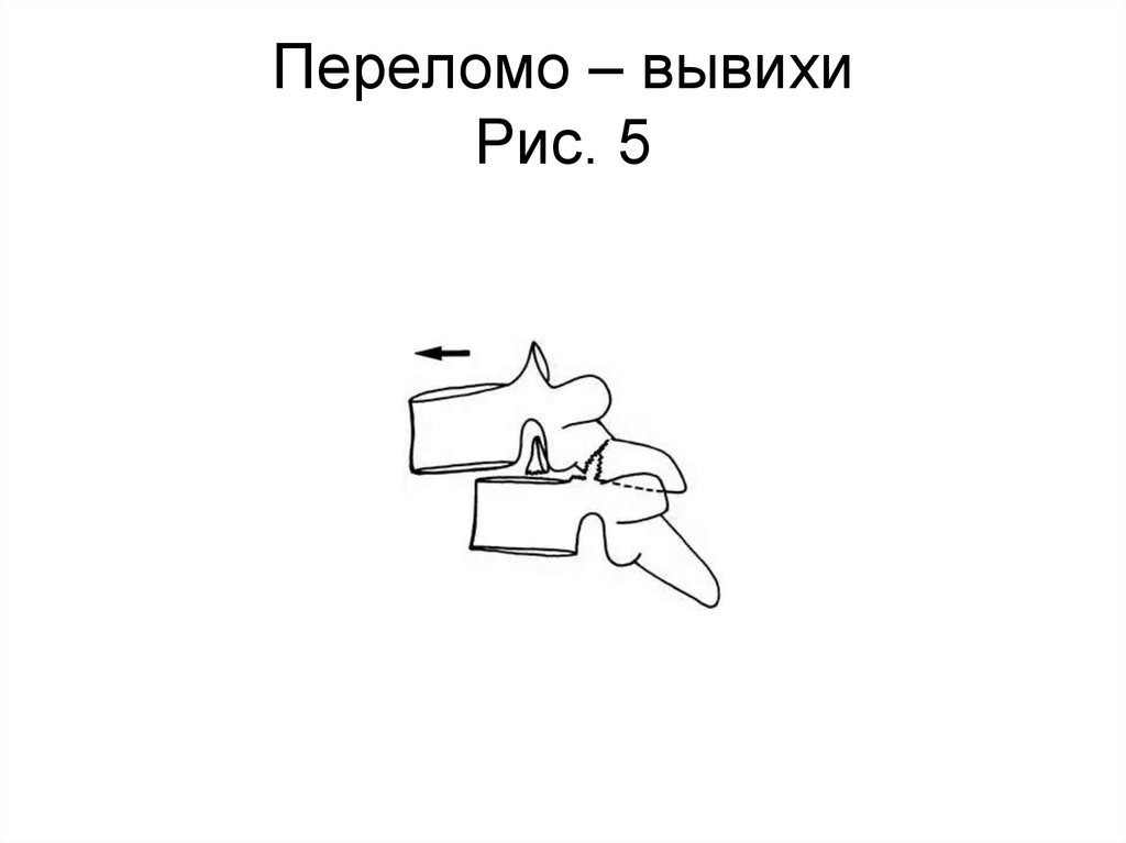 Переломо – вывихи Рис. 5