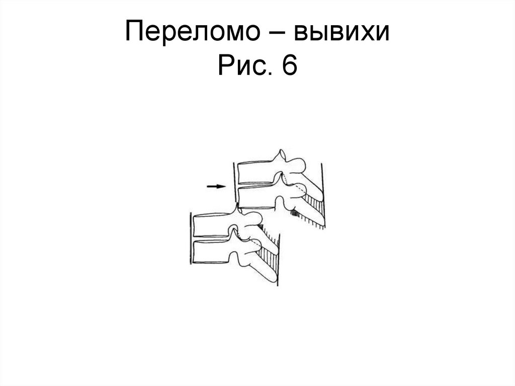 Переломо – вывихи Рис. 6