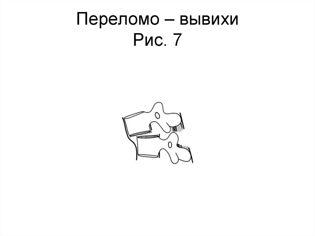 Переломо – вывихи Рис. 7