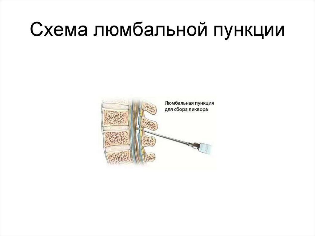Схема люмбальной пункции