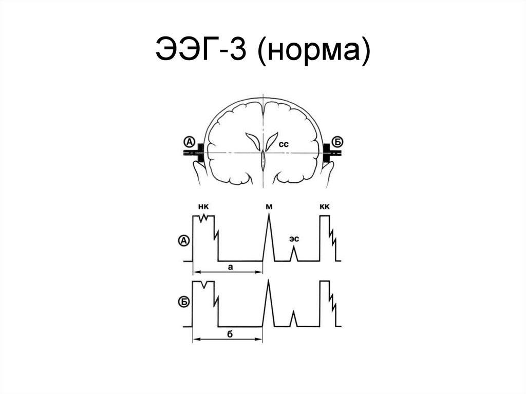 ЭЭГ-3 (норма)