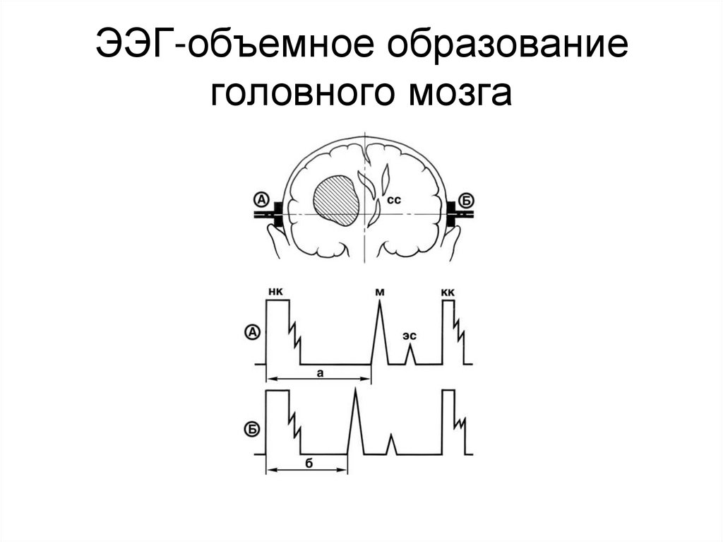 ЭЭГ-объемное образование головного мозга